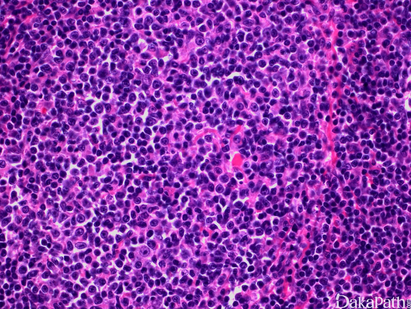 图317 非霍奇金淋巴瘤淋巴结涂片-血液学细胞学-医学