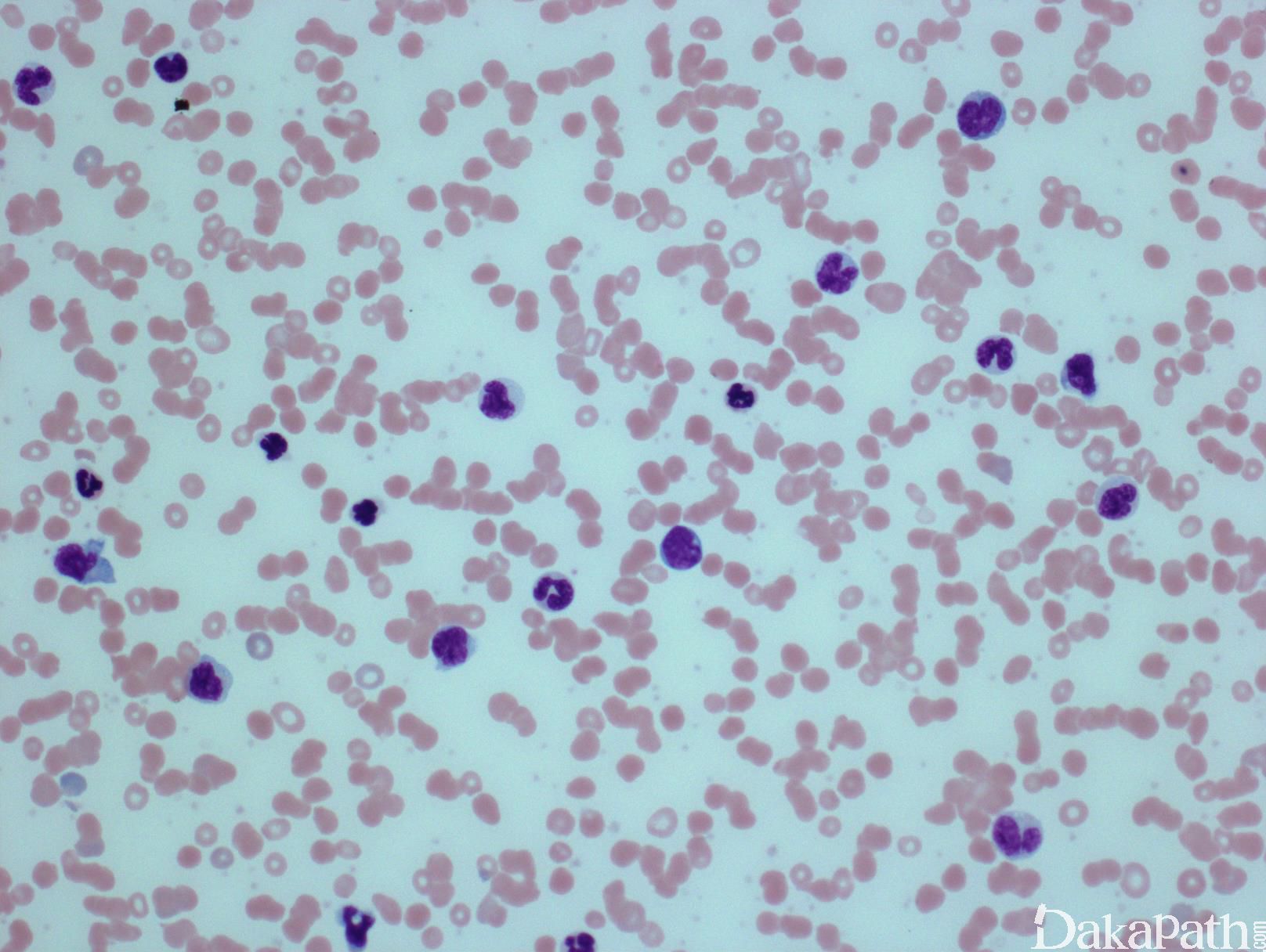 急性原单和单核细胞白血病