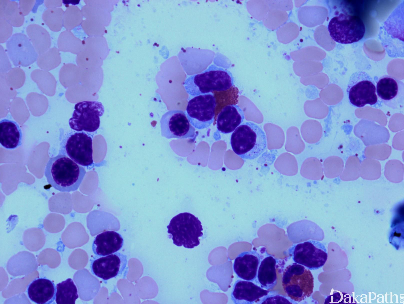 图214 慢性中性粒细胞白血病骨髓象-血液学细胞学-医学