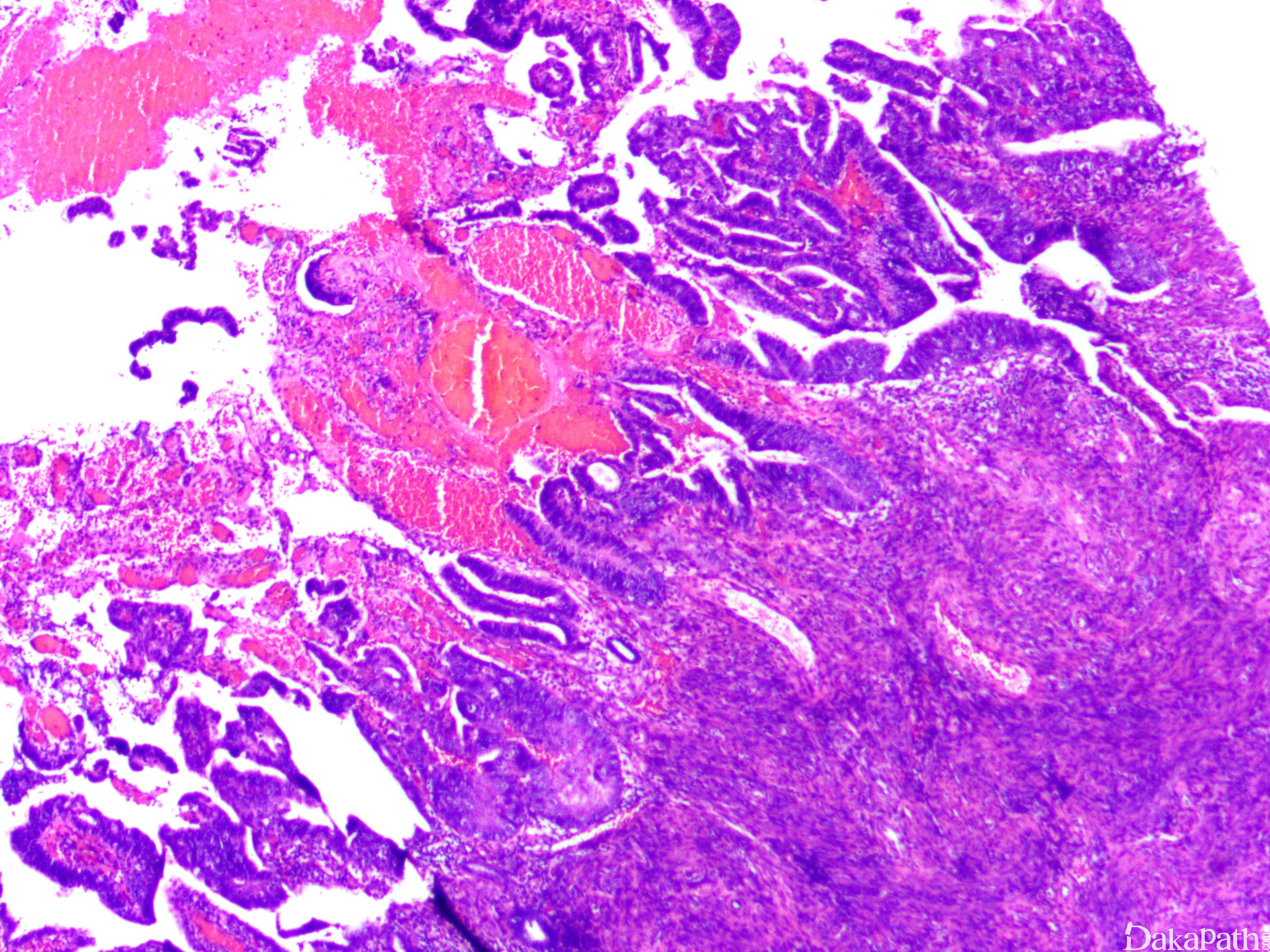 宫体 POLE 突变型内膜样癌合并HPV感染相关性宫颈腺癌1例报道及文献回顾