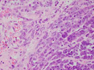 肺腺癌 ステージ4 抗がん剤