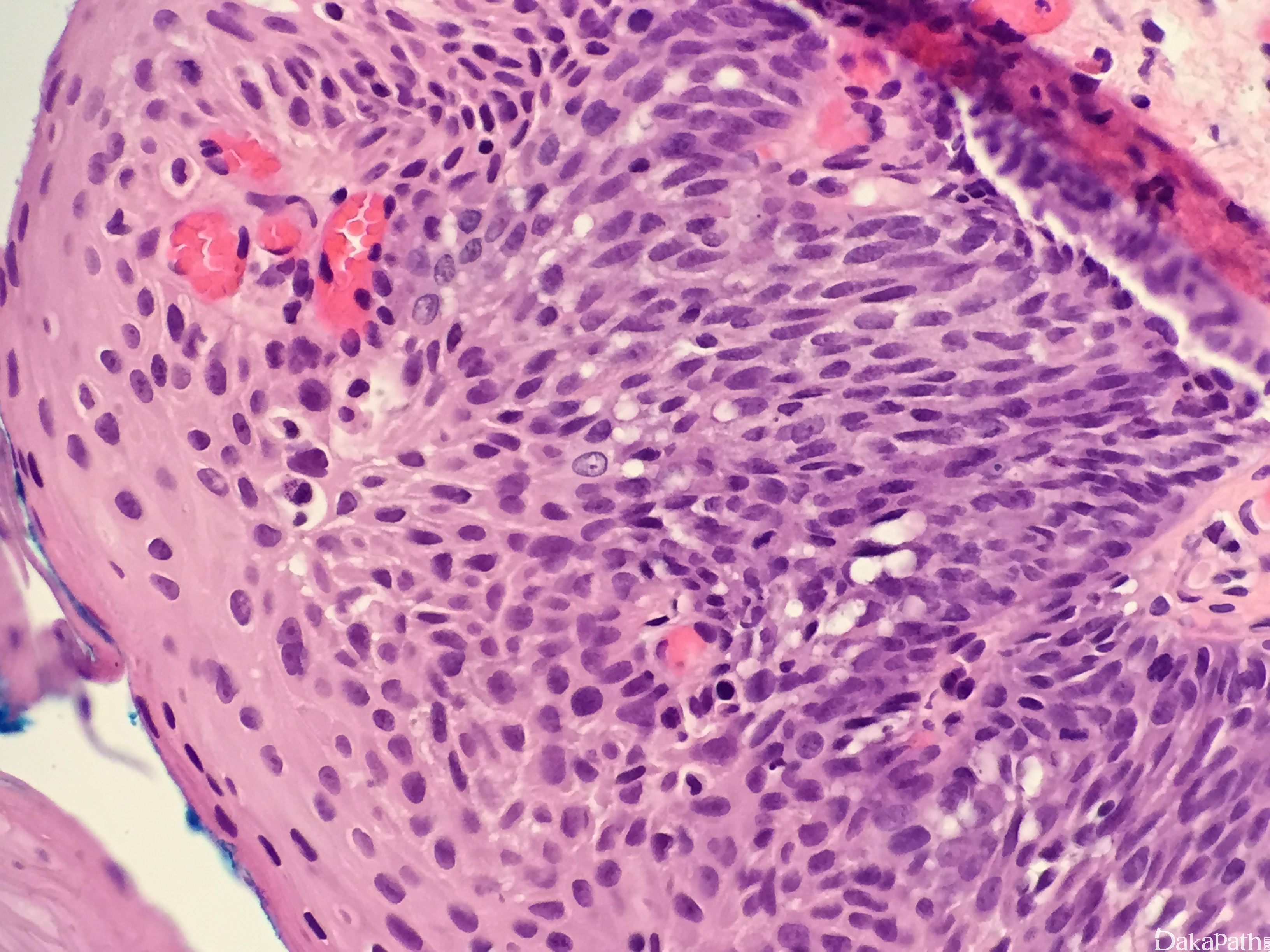 梭形细胞鳞状细胞癌