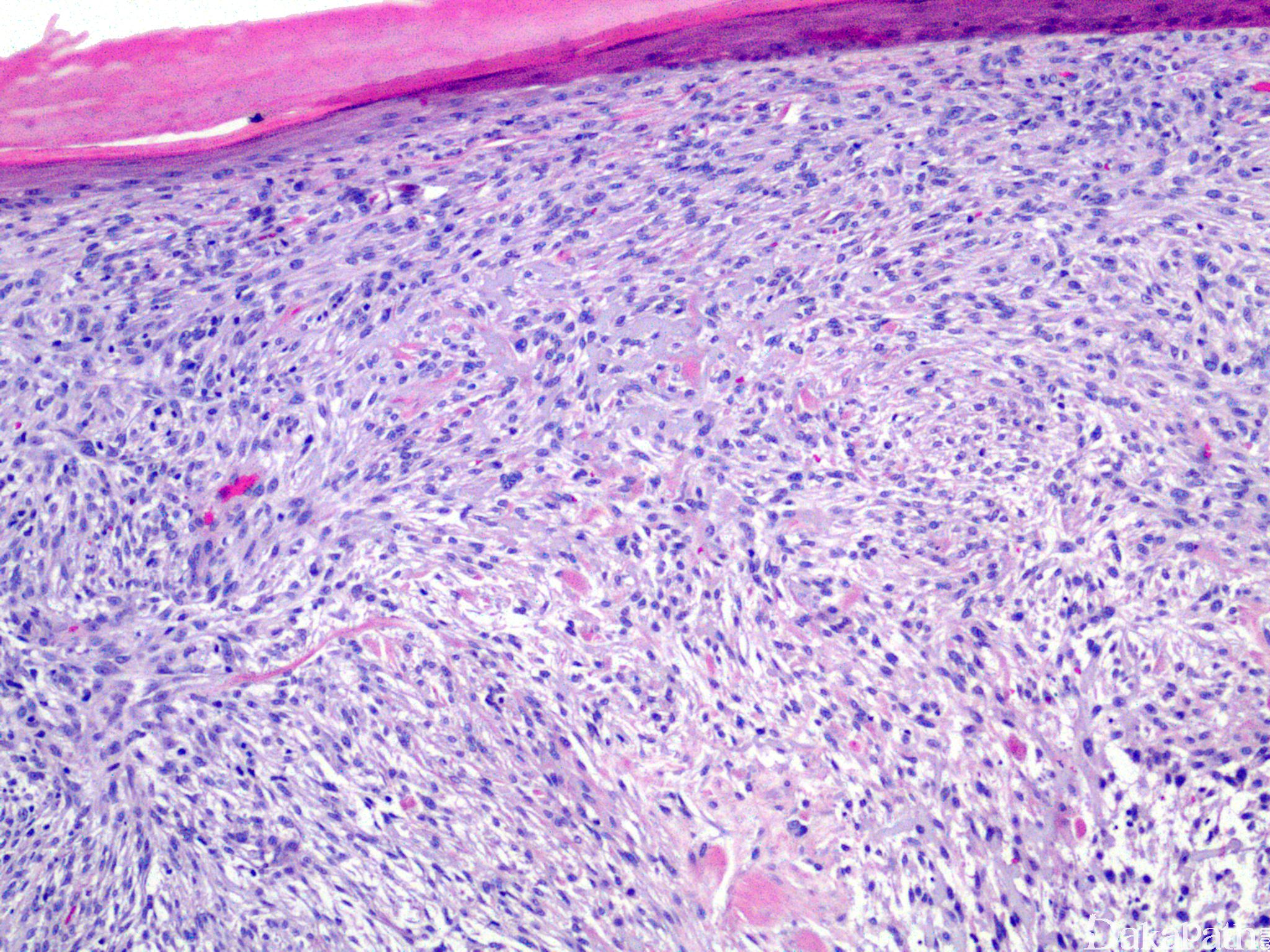 前列腺小细胞神经内分泌癌
