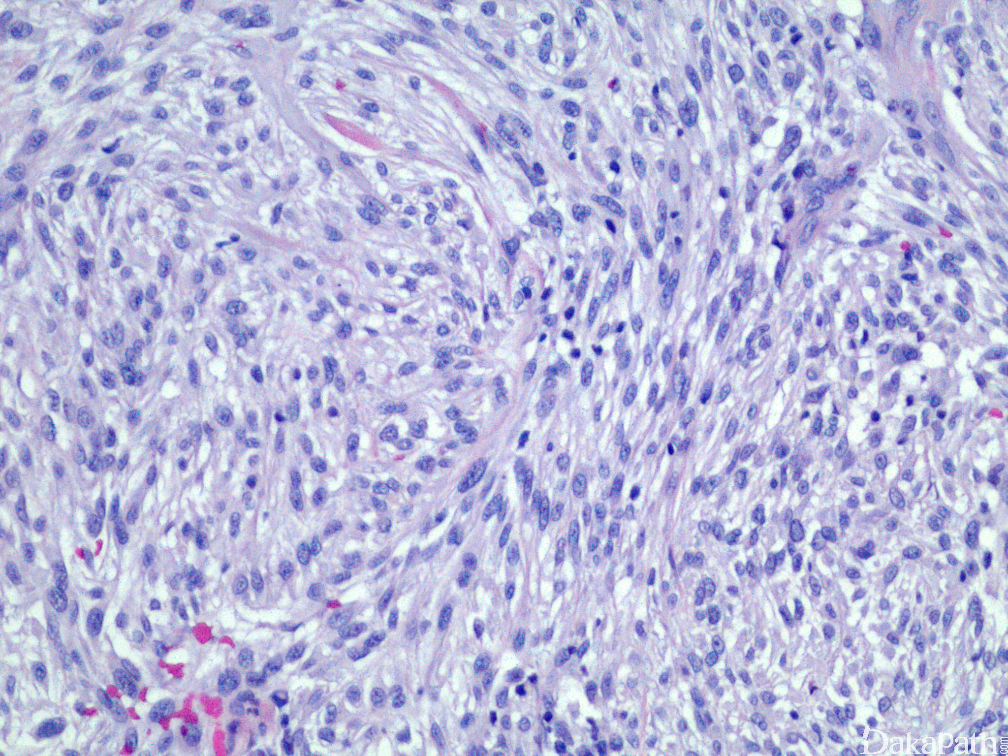 图22 鳞状细胞癌(原位癌)-基础医学-医学