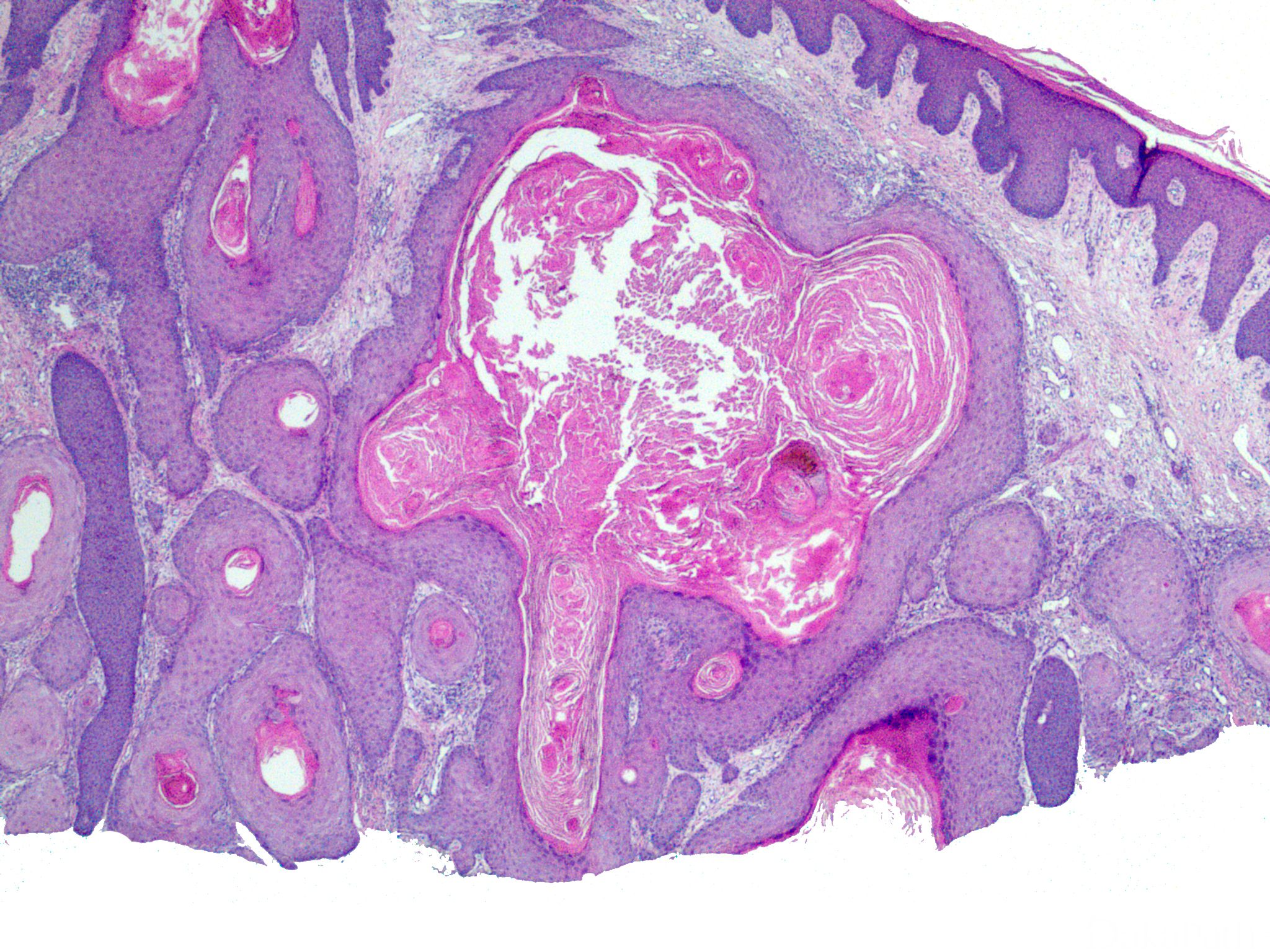 鳞状细胞癌皮肤,鳞状细胞巢,鳞状细胞图片皮肤_大山谷图库