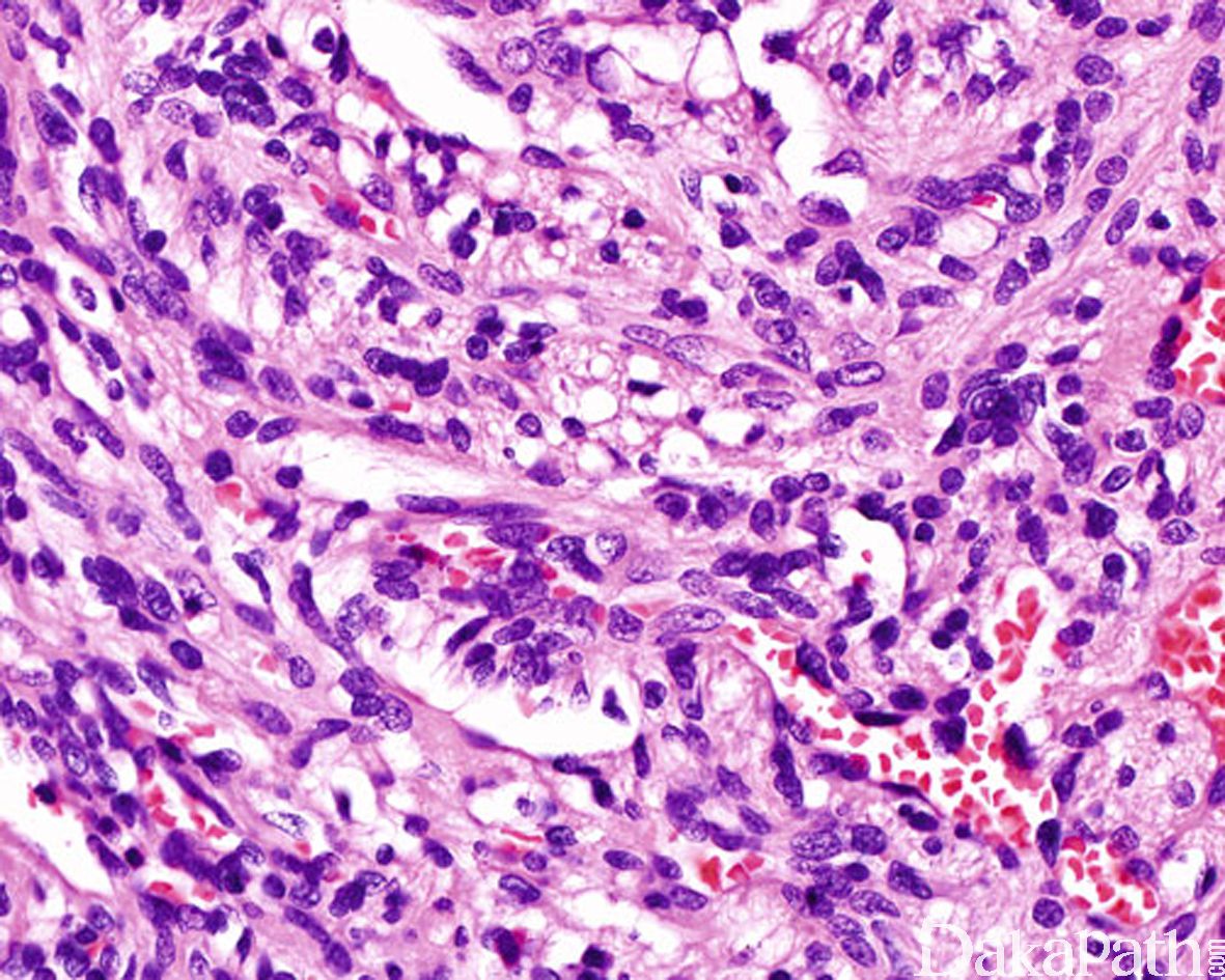 肝上皮样血管内皮细胞瘤3例报告