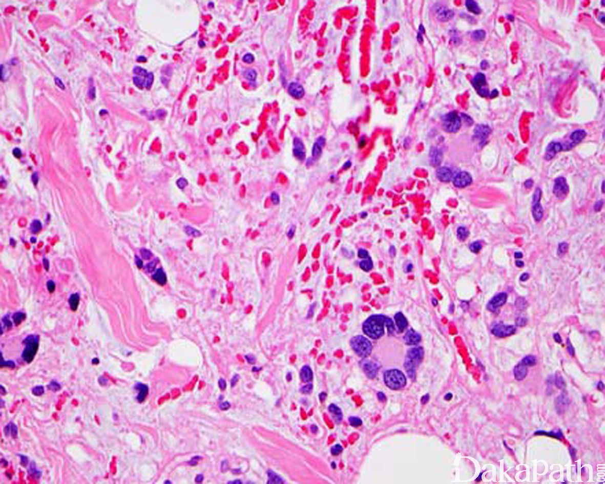 第三节 脂肪瘤-颌面颈部疾病影像学图鉴-医学