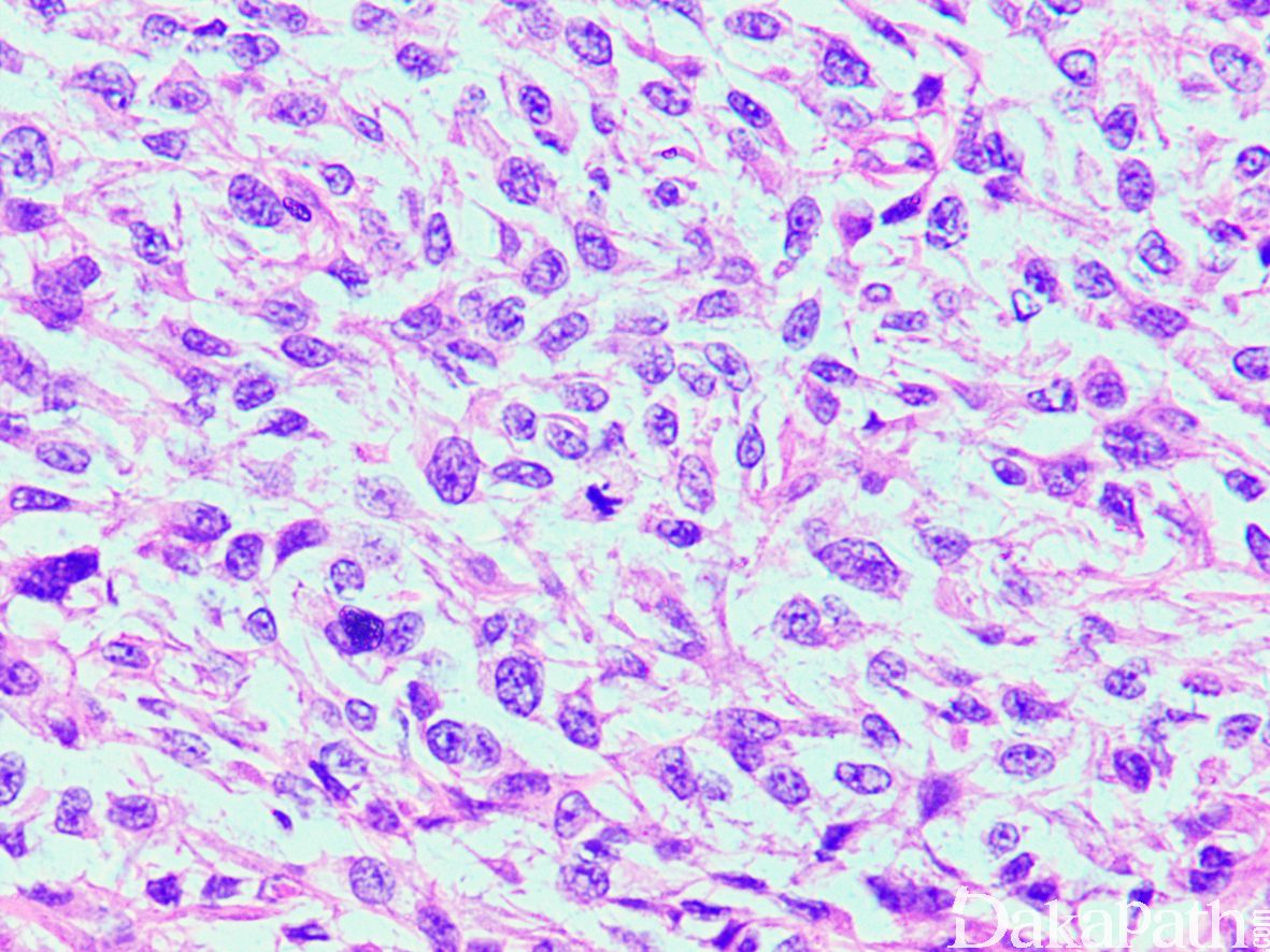 滤泡树突细胞肉瘤