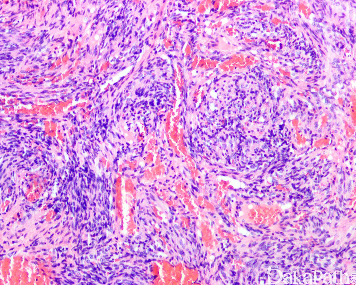 梭形细胞血管瘤