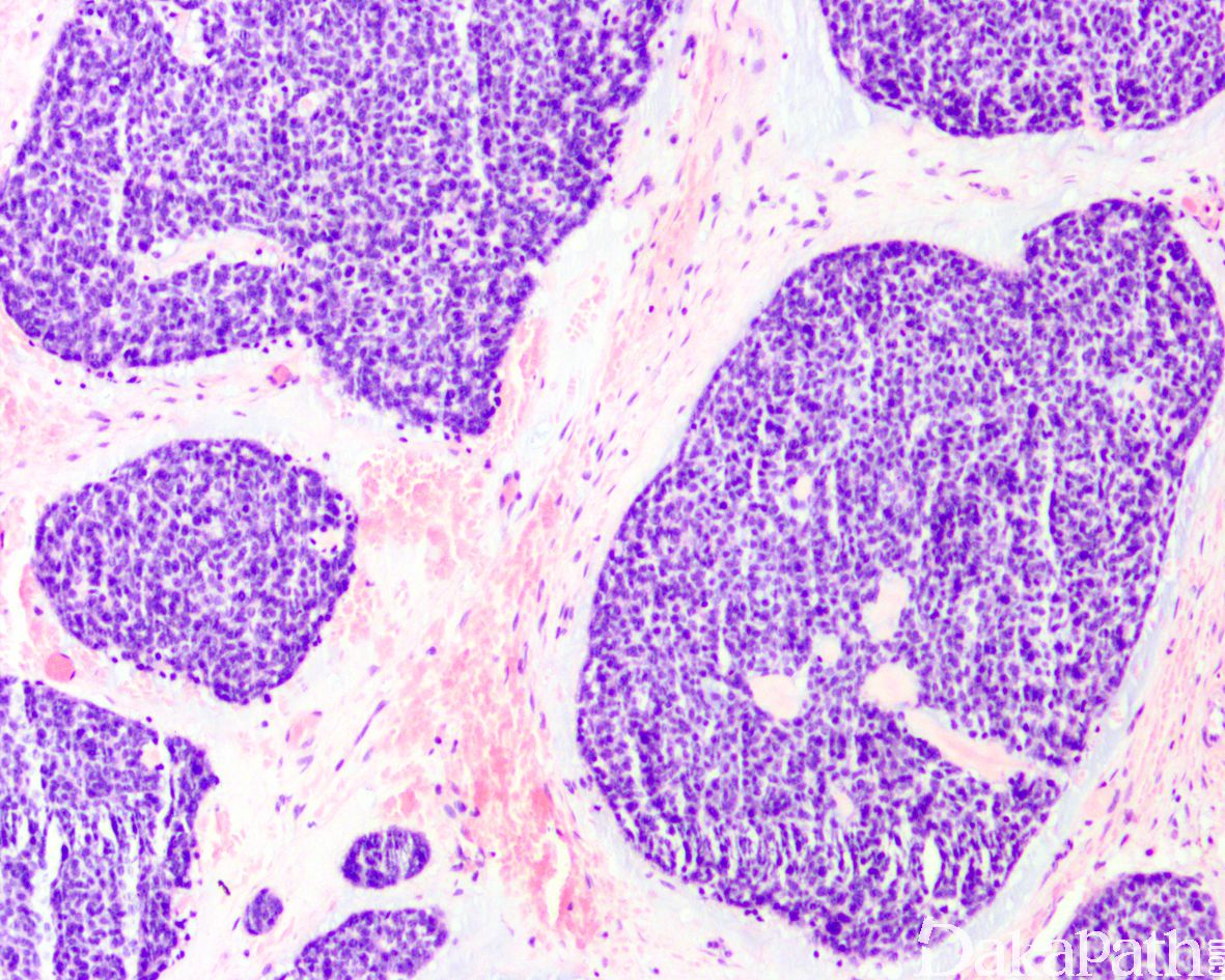 前列腺小细胞神经内分泌癌