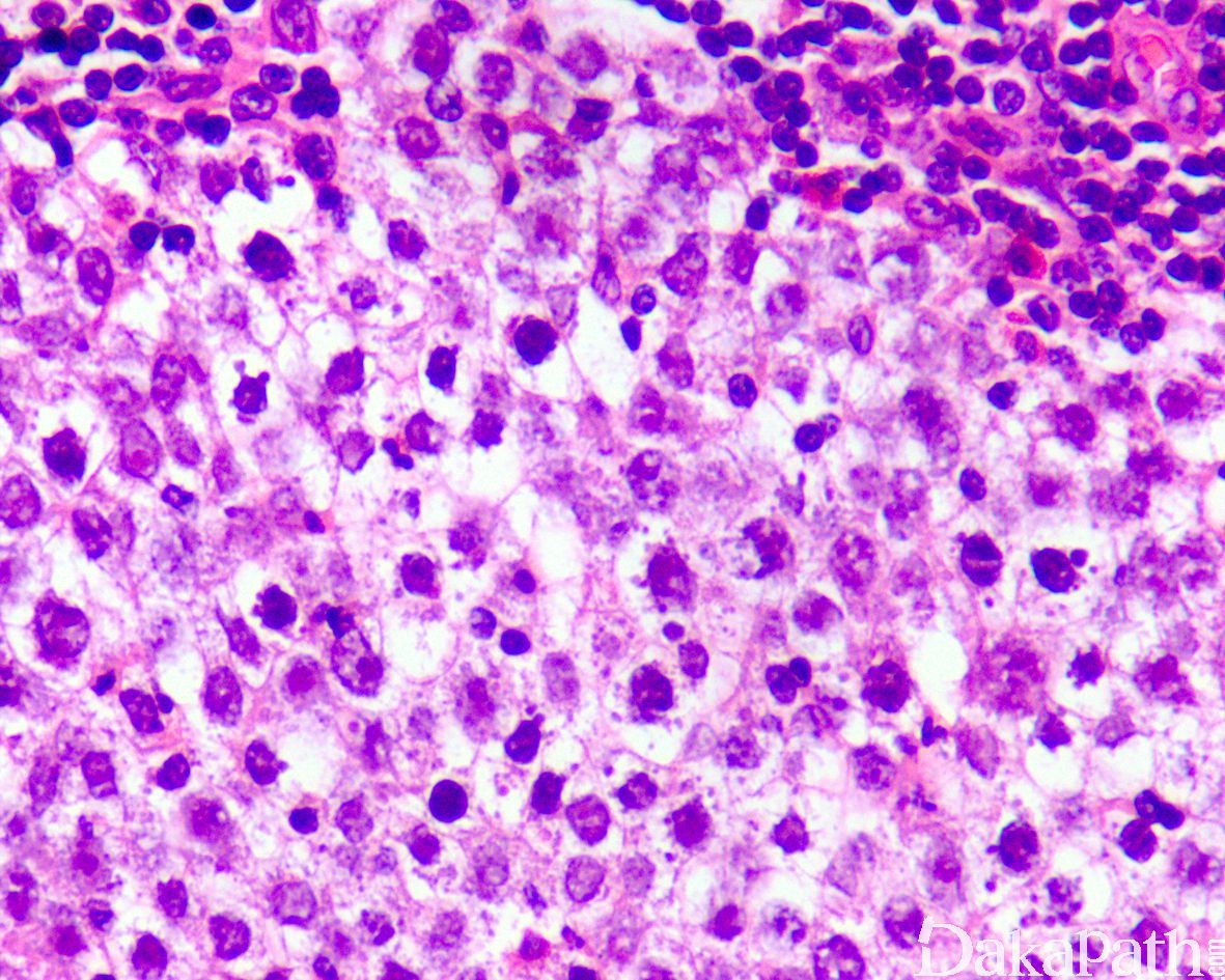 浆细胞骨髓瘤