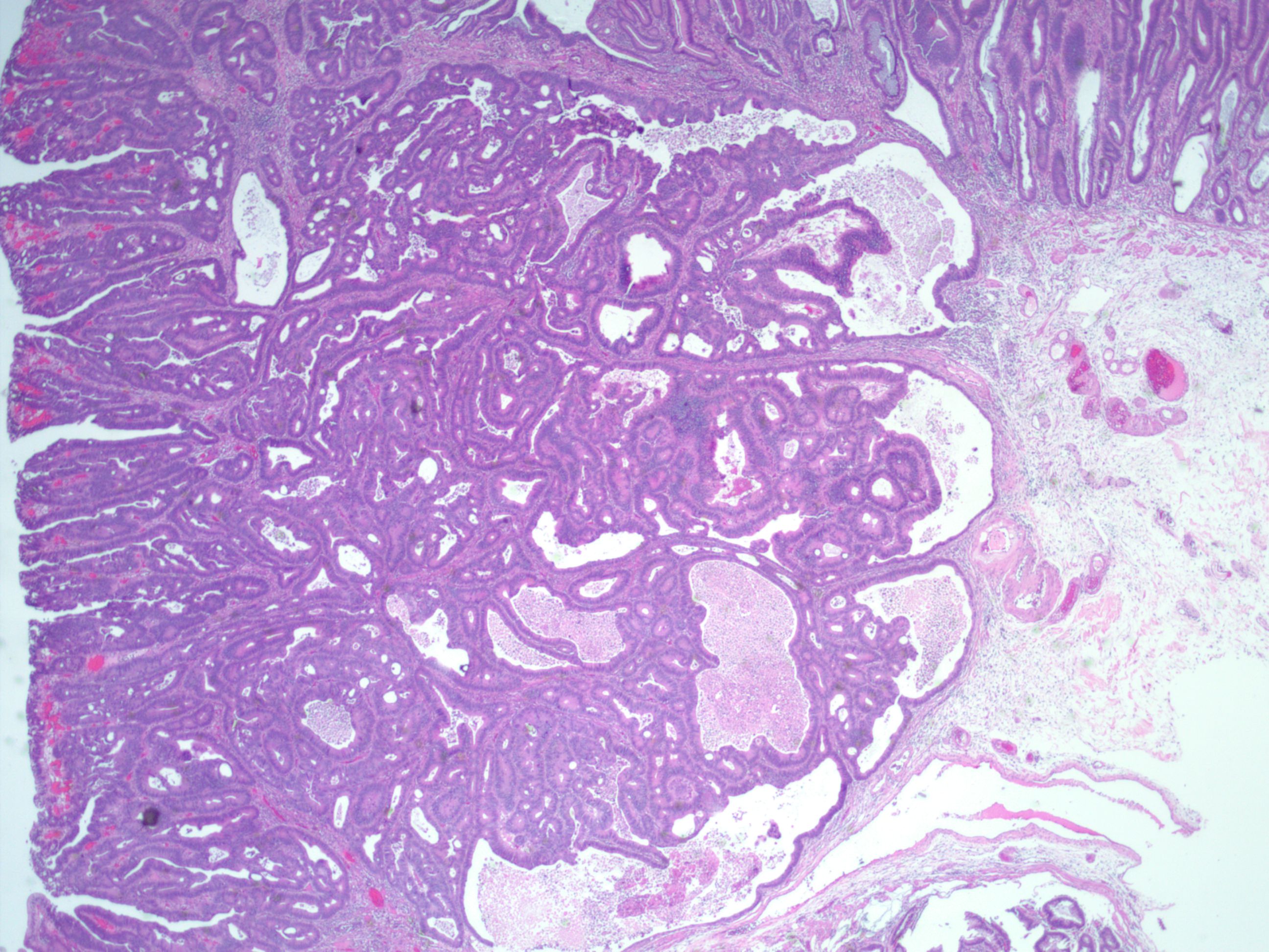 结肠管状腺瘤病理图片图片