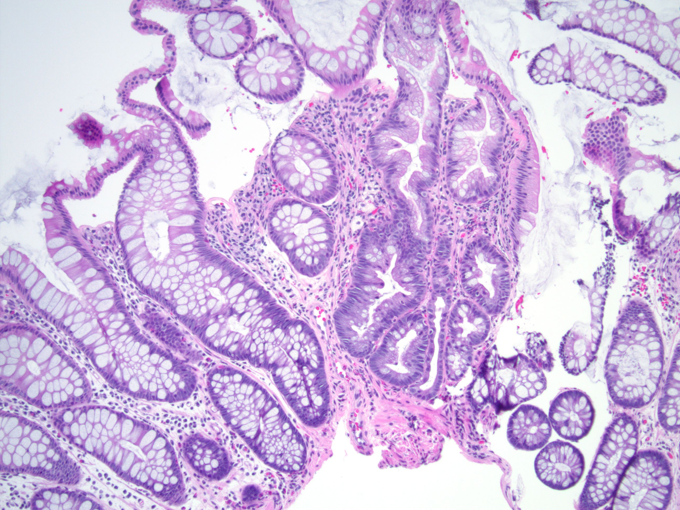 GC-C -/- 小鼠在DSS诱导下肠道炎症损伤的变化