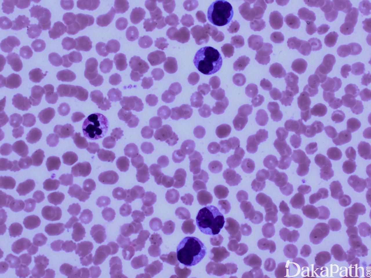 白血病患者血液涂片的显微镜观察照片摄影图片_ID:166180634-Veer图库