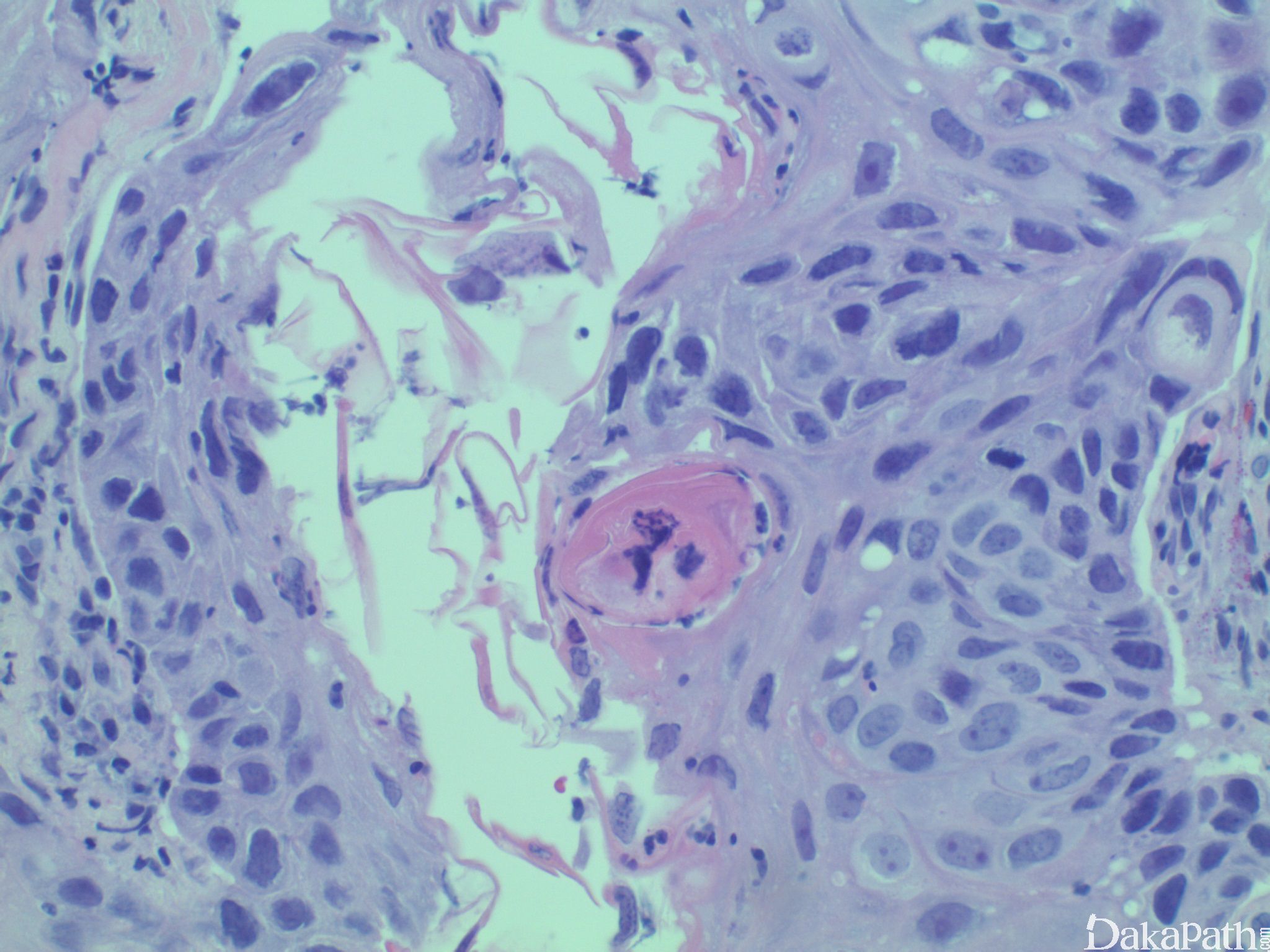 角化棘皮瘤型鳞状细胞癌