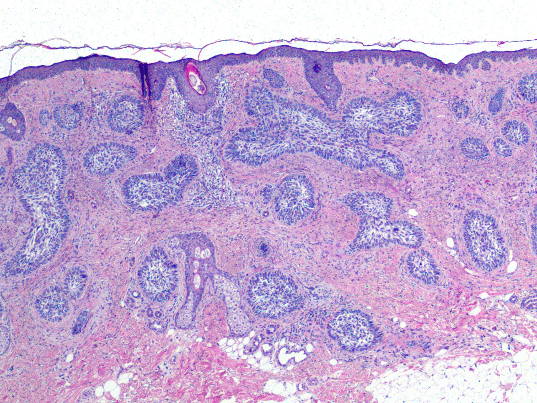 图317 非霍奇金淋巴瘤淋巴结涂片-血液学细胞学-医学