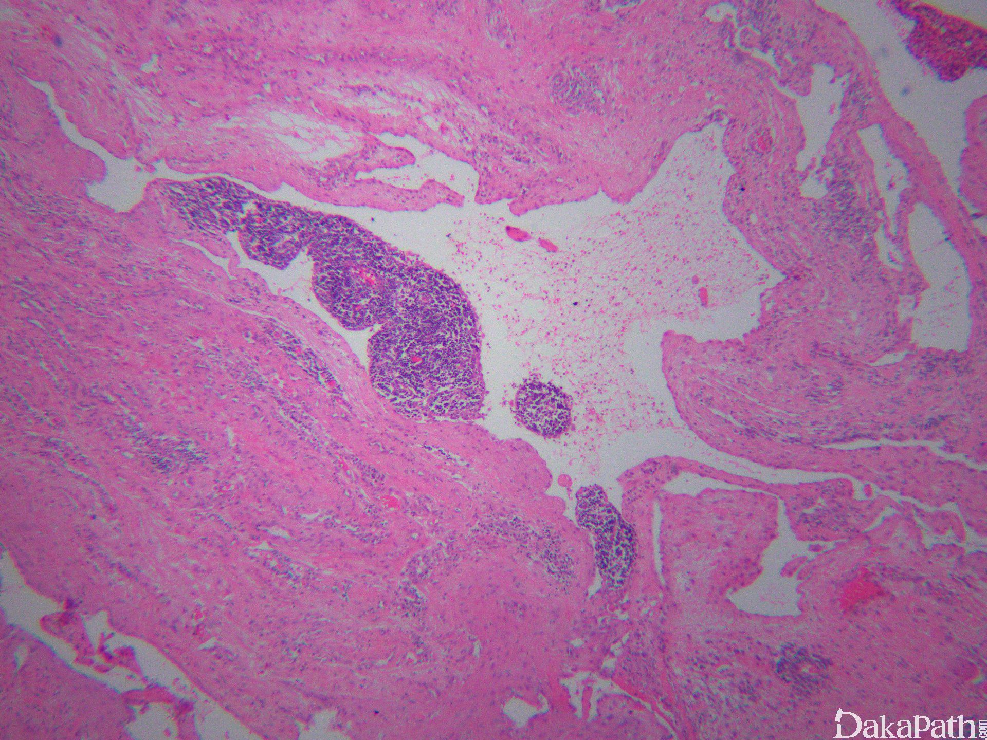 海绵状淋巴管瘤图片图片
