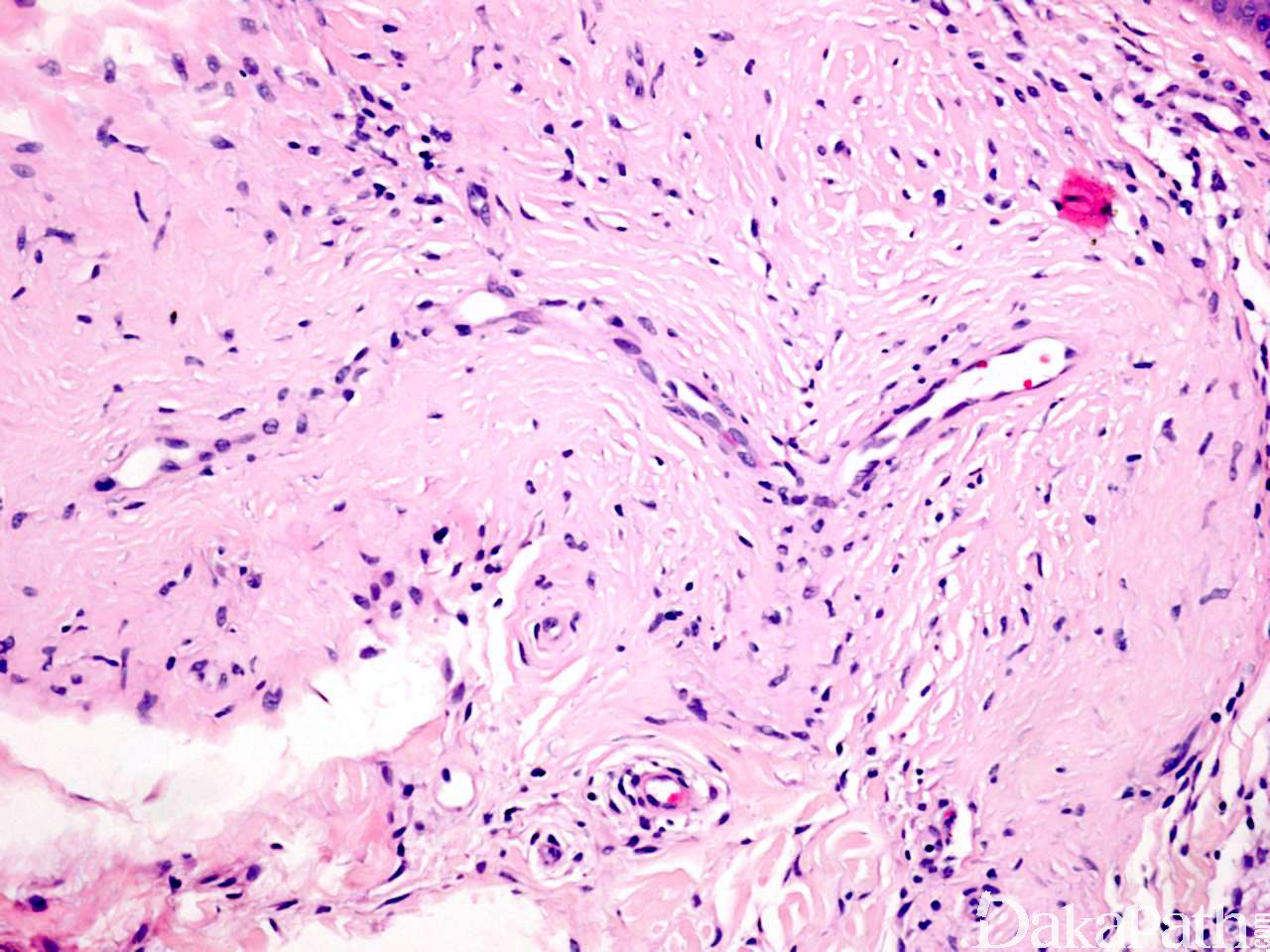 毛囊漏斗型基底细胞癌