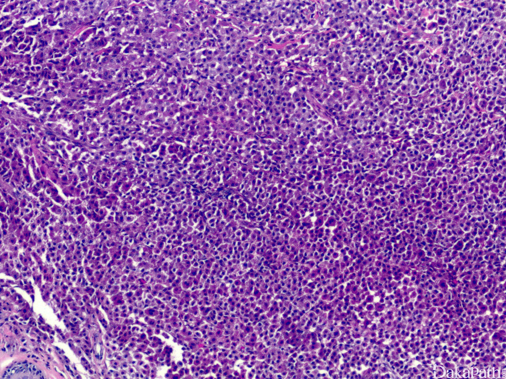 婴儿肥大细胞瘤图片图片