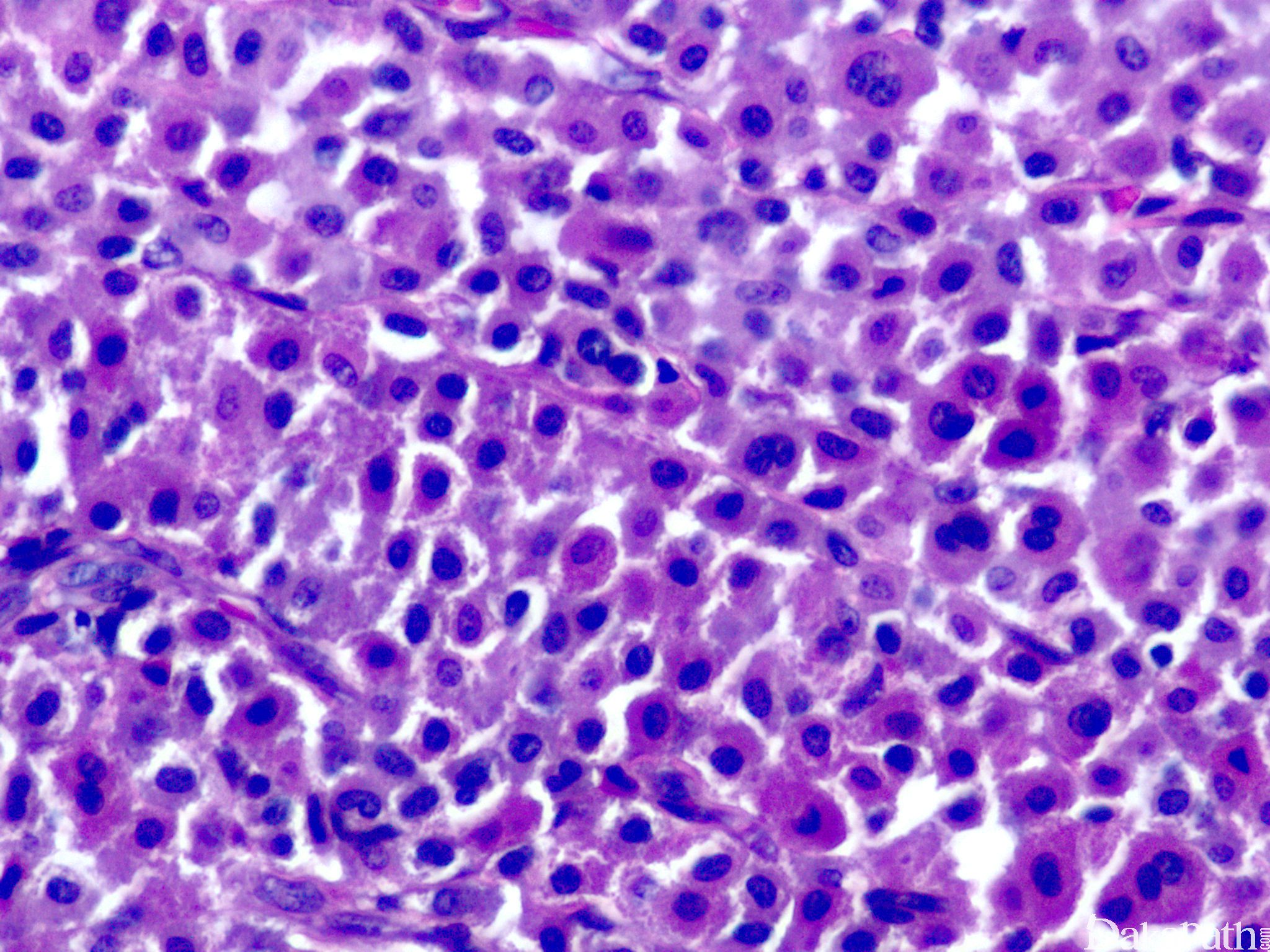 瘤巨细胞图片图片