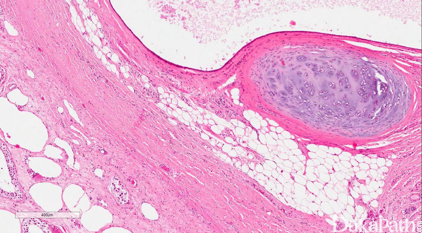 睾丸间质细胞瘤