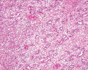 肉芽组织炎细胞图片