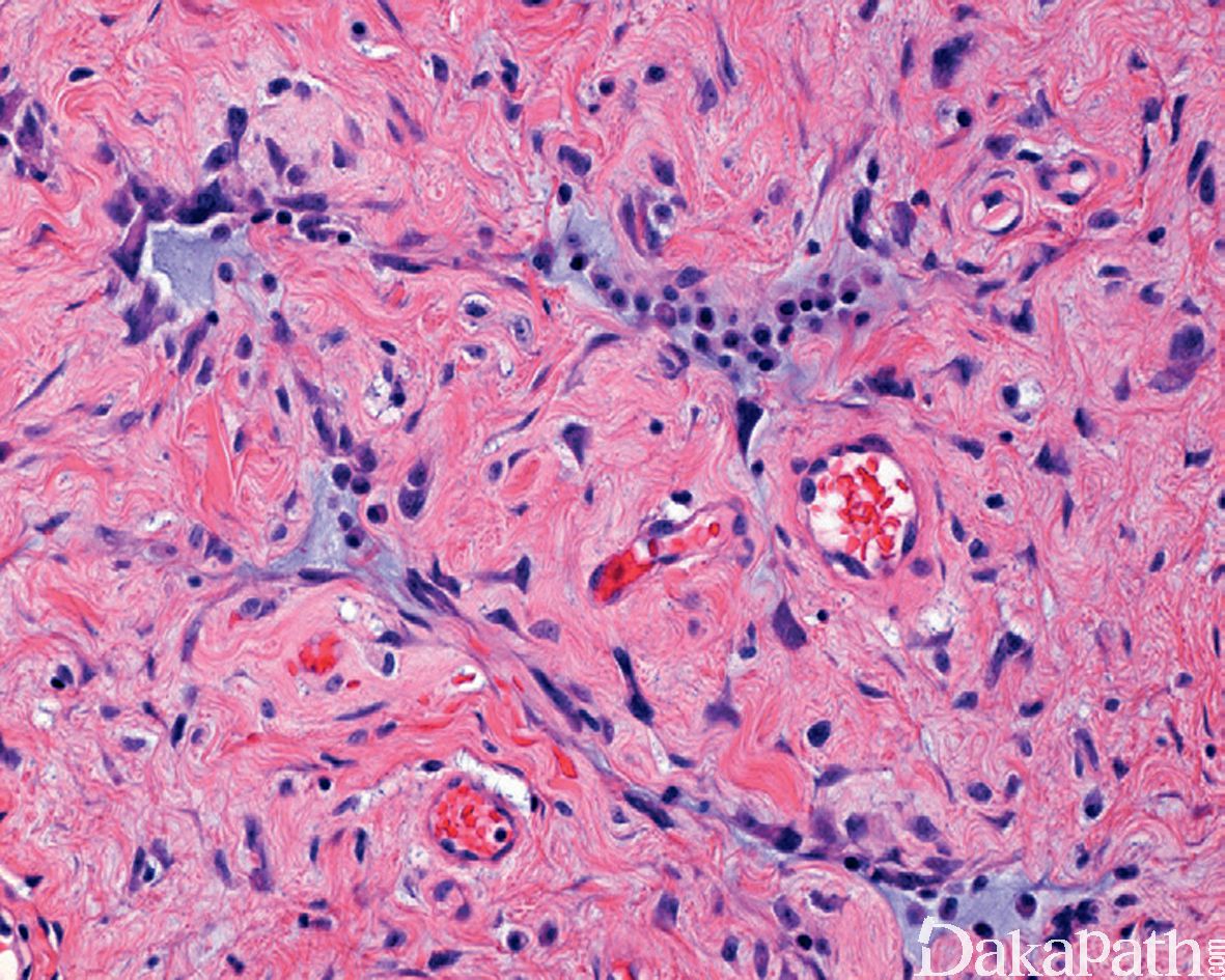 中华医学会核医学分会 病例报告 （145）骨的巨细胞瘤99mTc-MDP骨显像与18F-FDG PET/CT表现