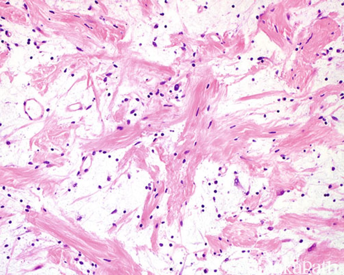 炎性肌纤维母细胞瘤
