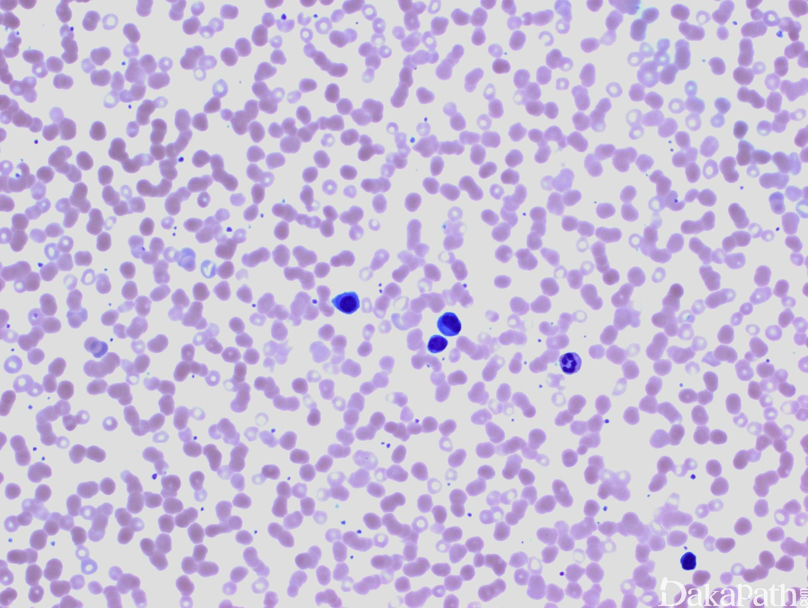 图Ⅰ-39 浆细胞-肿瘤学-医学