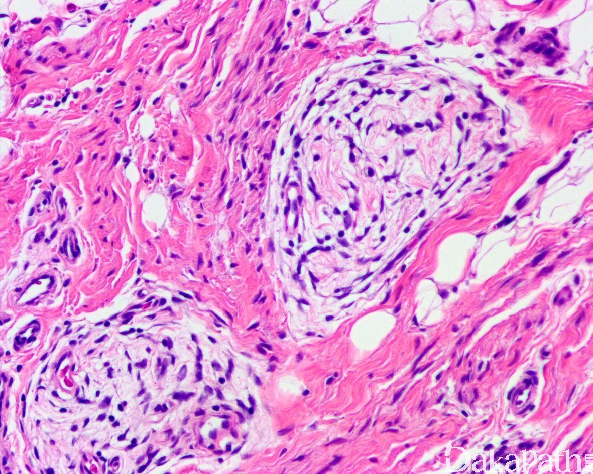 婴儿肥大细胞瘤图片图片