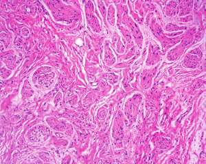 神经束膜瘤图片