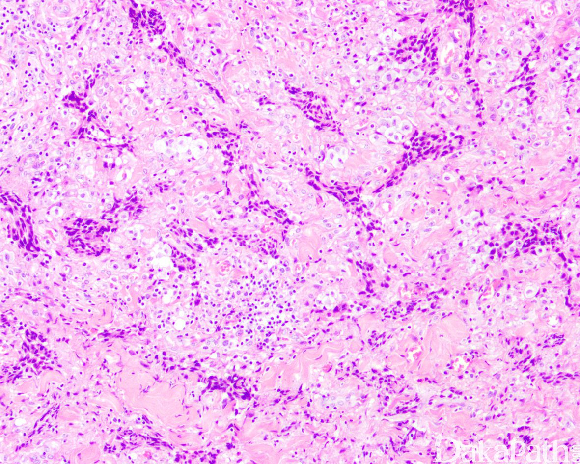 EWSR1-NFATC2基因异位相关肉瘤：一种罕见的侵袭性原发骨或软组织肿瘤的临床病理特征研究91360智慧病理网(手机版)