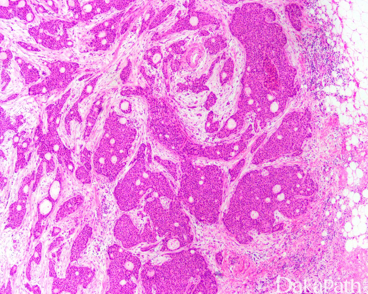 “曲”径通“优”，明效大验丨一例获pCR的HER2+炎性乳腺癌的病例分享-肿瘤瞭望