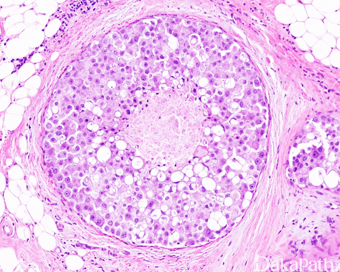 乳腺恶性疾病：特殊形式的乳腺癌的MRI表现 - 乳腺肿瘤学 - 天山医学院
